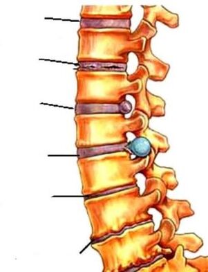 osteocondritis of the spine