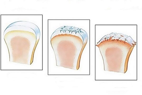 joint damage at different stages of arthrosis development