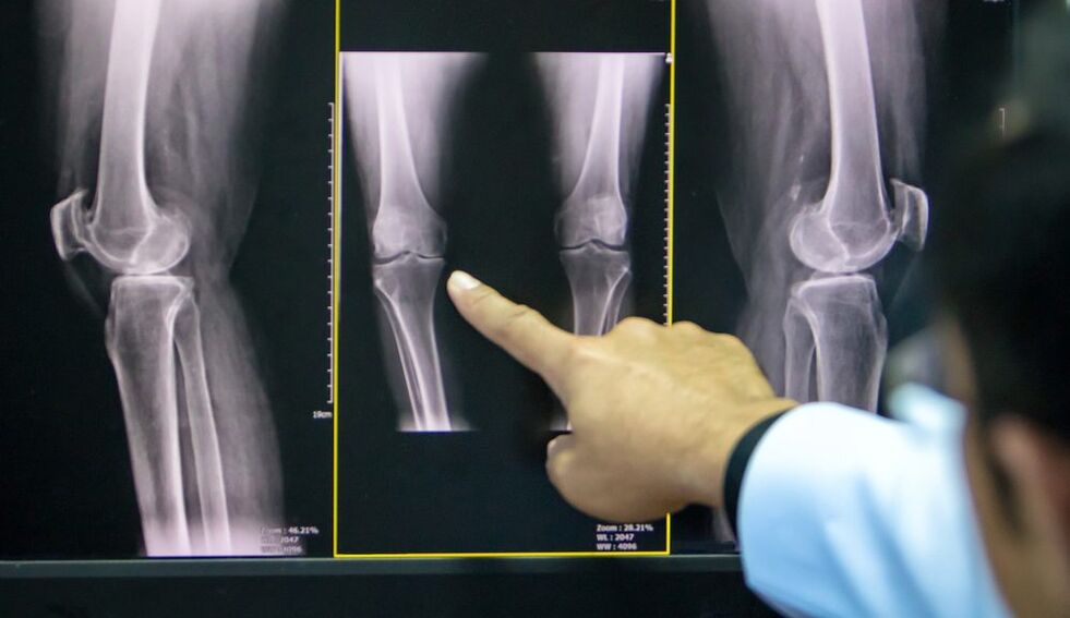 arthrosis of the knee x-ray