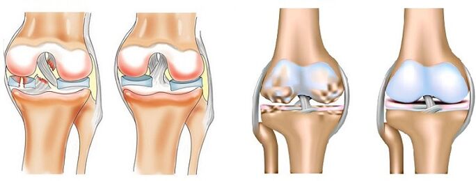 Difference between arthritis (left) and arthrosis (right) of the joints
