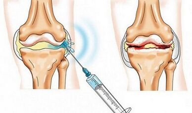 The blockade of the knee joint for arthrosis