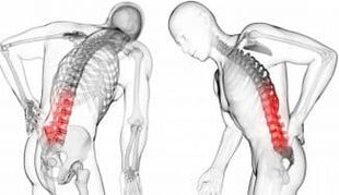 Intervertebral hernia - complication with osteochondrosis