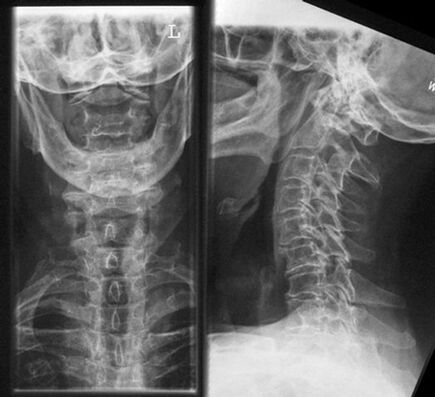 Cervical x -ray - method of diagnosis of osteochondrosis