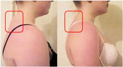 Formation of muscle roller with cervical osteochondrosis
