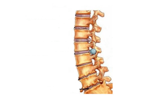 Damage to the spine with cervical osteochondrosis