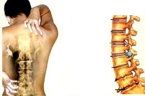 back pain at different stages of the development of cervical osteochondrosis