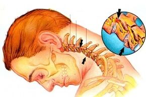 pinching of the nerve in the spine with cervical osteochondrosis